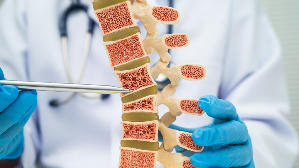 osteoporosis treatment